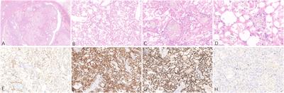 Acquired cystic disease-associated renal cell carcinoma with PTCH1 mutation: a case report